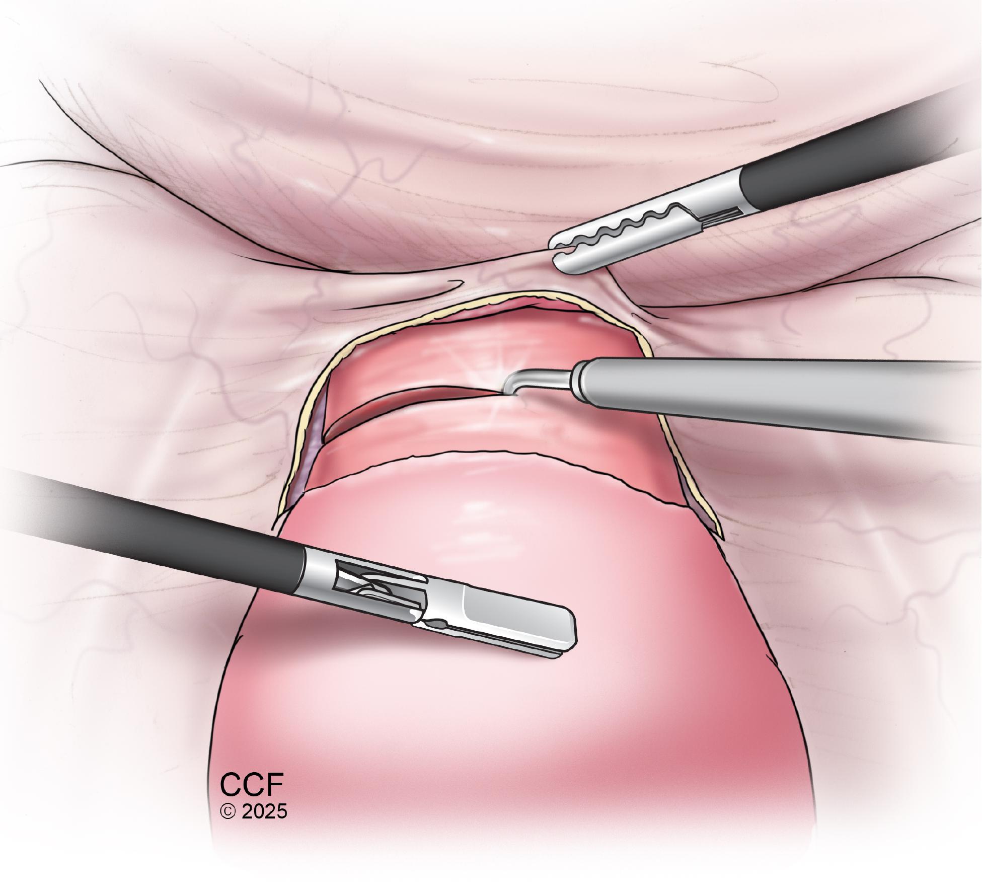 Robotic gynaecological surgery in progress
