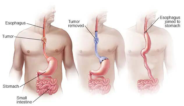 Robotic Oesophagus Surgery