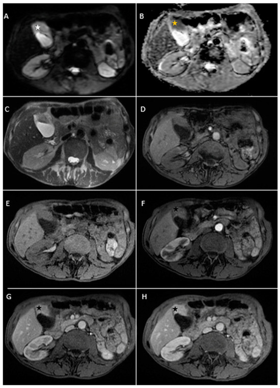 Gallbladder anatomy