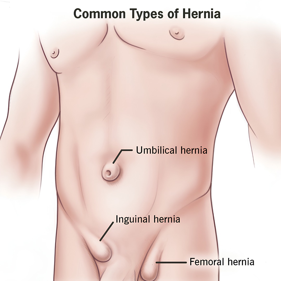 Robotic hernia surgery being performed at Novo Robotic Surgery Centre