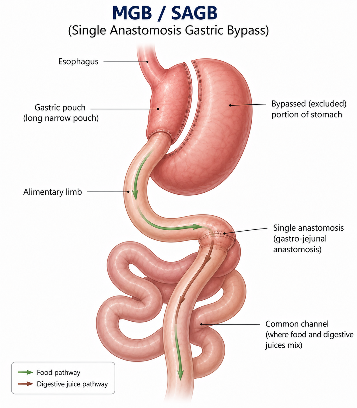 Illustration of the mini gastric bypass anatomy
