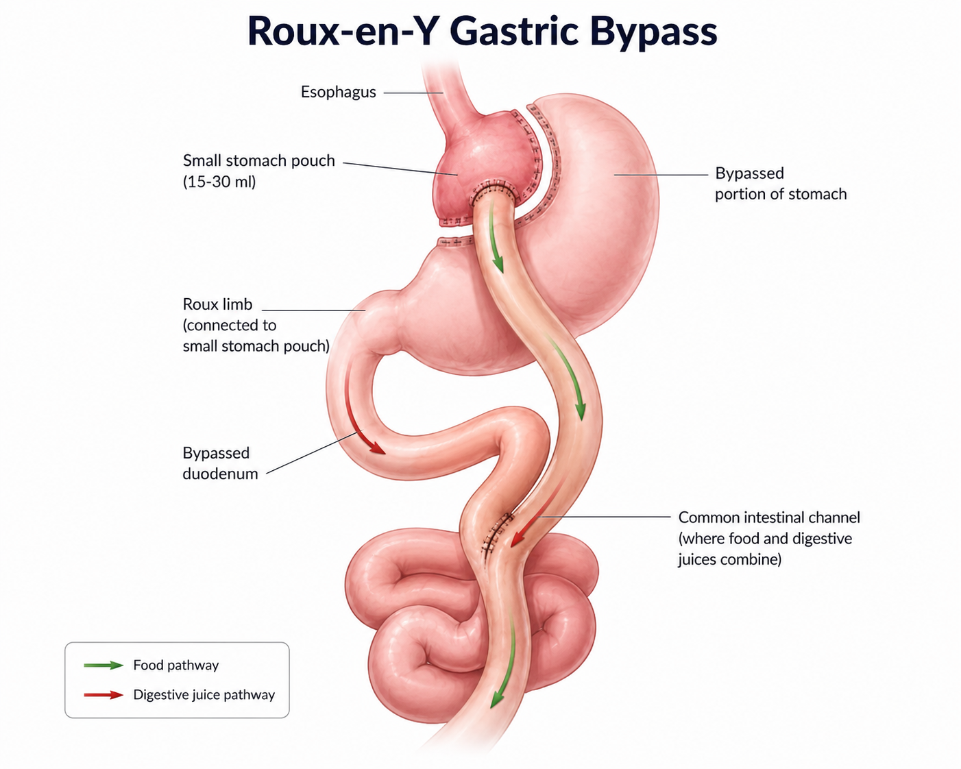 Anatomical illustration of the Roux-en-Y gastric bypass
