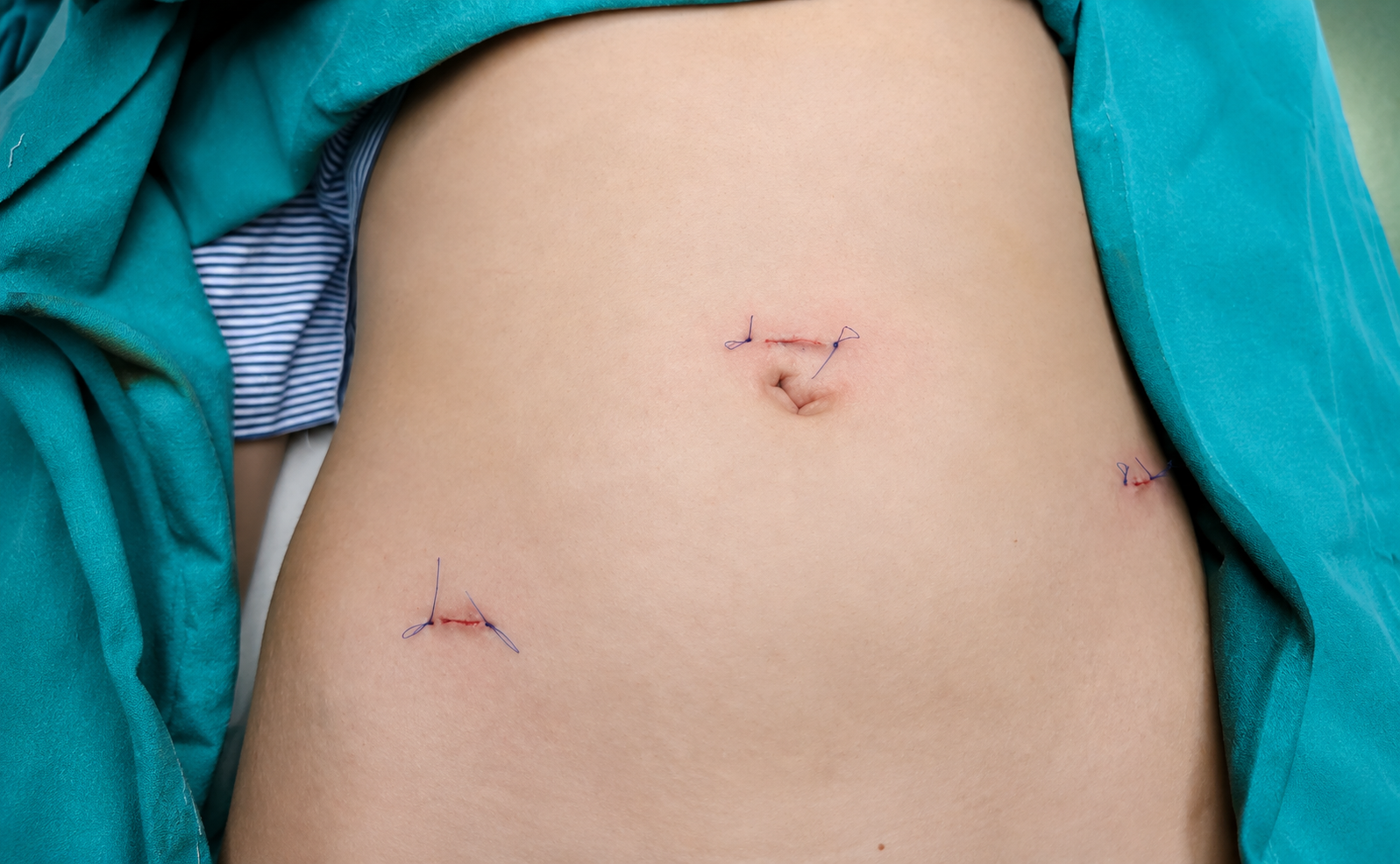Small Incisions